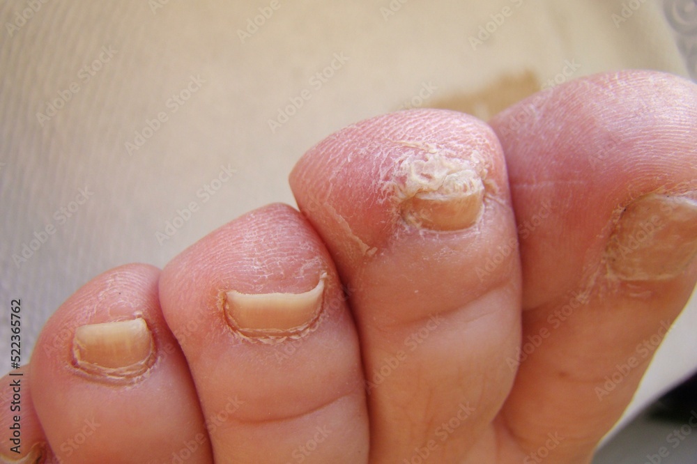 topical antifungal treatment is seen in the big toe of a person