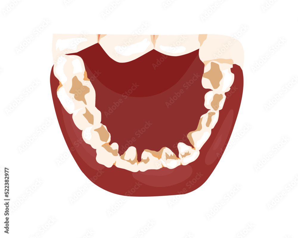 calculus deposits exhibited on the lingual surface of the mandibular
