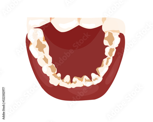 calculus deposits exhibited on the lingual surface of the mandibular anterior teeth ,along the gum line are signs that needs professional cleaning from dentist