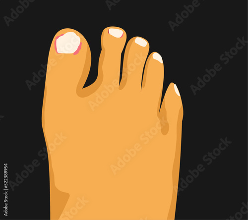 illustration of paronychia, an inflammation of the skin around the nail, infographic of paronychia - vector