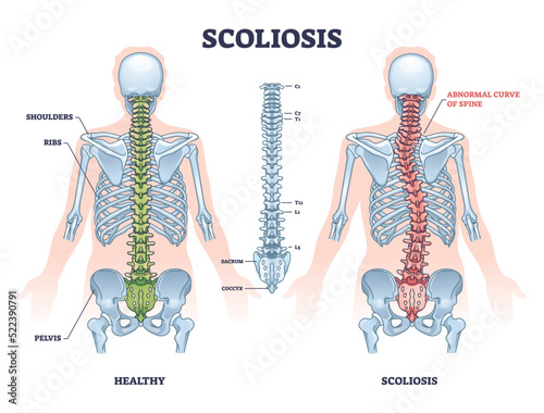 Scoliosis as medical sideways curvature illness of spine outline diagram. Labeled educational scheme with healthy and abdominal backbone skeleton comparison vector illustration. Deformity posture. photo