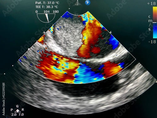 Transesophageal echocardiogram (TEE) shown left atrial (LA) myxoma .