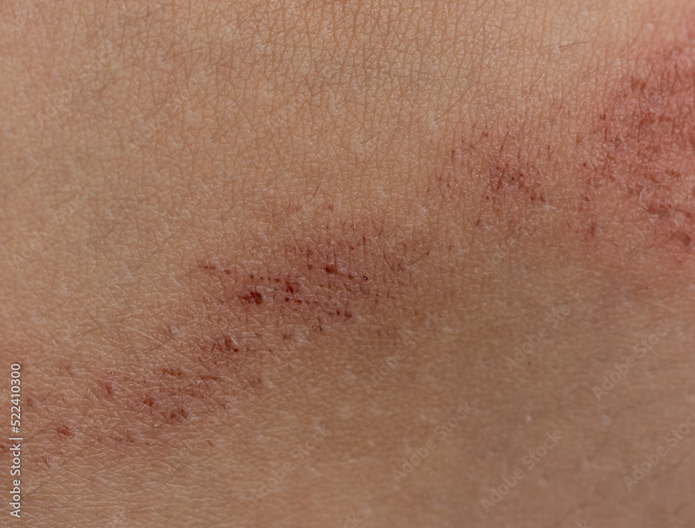Fototapeta premium scratches on the skin as a background