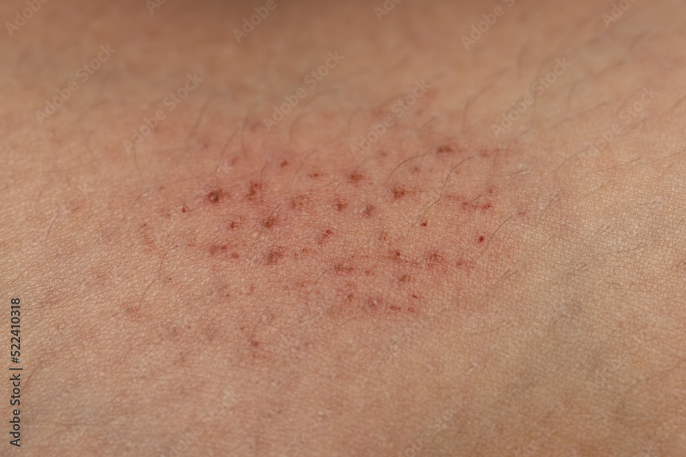 Fototapeta premium scratches on the skin as a background