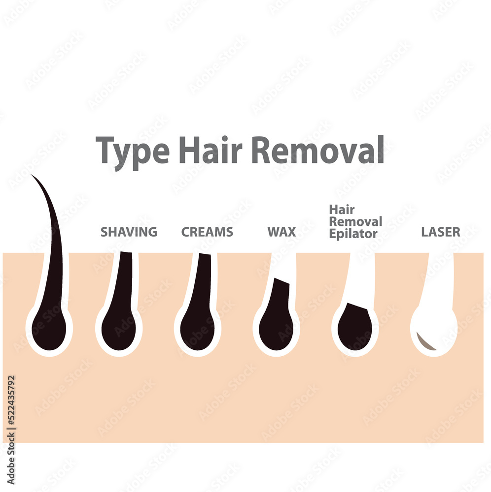 Vecteur Stock Hair removal concept, types of hair removal. Shaving,  depilation cream, waxing, epilator, plucking, laser hair removal. Vector |  Adobe Stock