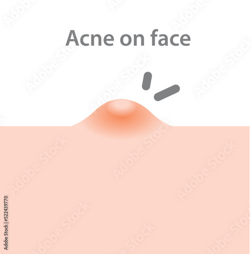 Acne on face closeup, Acne Closeup, close-up of bacteria that cause skin disease