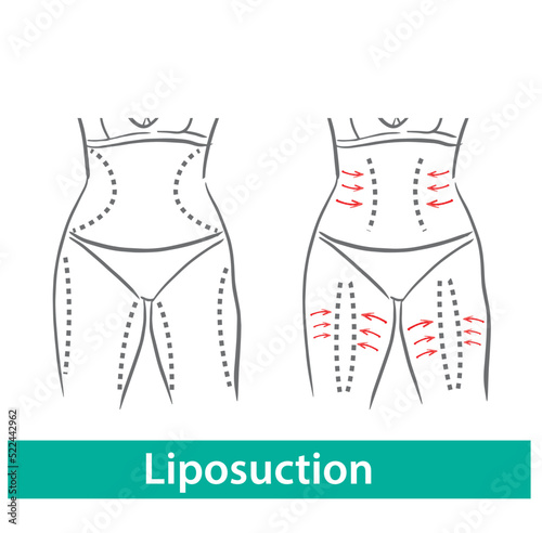 Liposuction drawing arrows. Liposuction and cellulite removal.