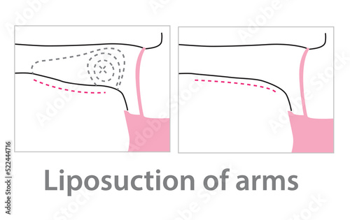 Liposuction of arms. Plastic surgery. Vector illustration of Arm with dotted line.