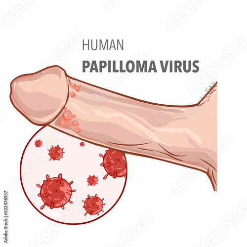 Vector illustration of human papilloma virus on penis