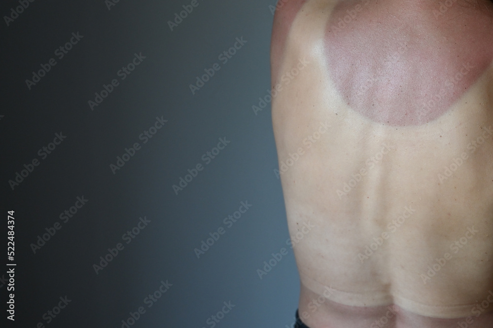 Fototapeta premium Close up of young naked woman with sunburn marks on the body, studio gray background