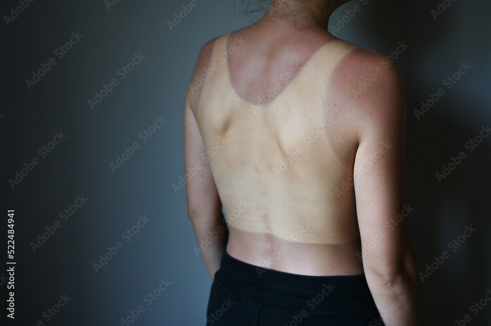 Obraz premium Young woman with sunburned back. Sun protection factor concept