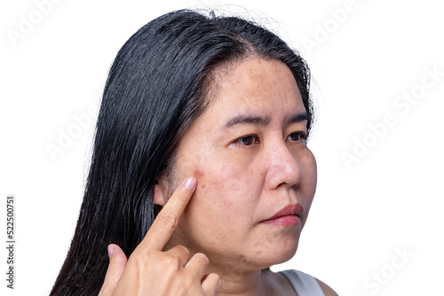 Close up of Asian adult woman face has freckles, large pores, blackhead pimple and scars problem from not take care for a long time. Soft focus of skin problem face. Treatment and Skincare concept