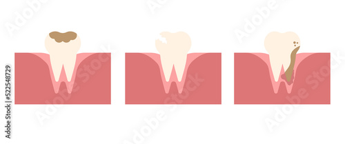 Set of various molars teeth isolated on white background. Vector flat cartoon illustration. Dental health concept. Oral care, dental diseases. Design for dental, dentist or stomatology clinic