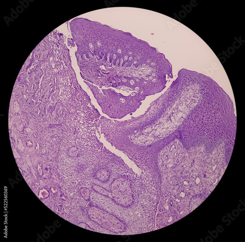 Microscopic tissue of retromolar region, show buccal mucosa, squamous hyperplasia with ulceration, mesenchymal element, blood vessel. Hamartomatous lesion.