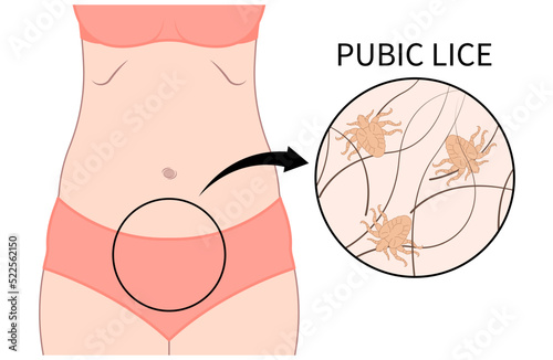 Bed Bugs tick or Pubic lice Tiny egg infection body