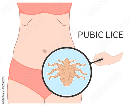 Pubic lice on body with tiny Bed Bugs tick egg infection