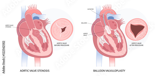 atresia of mitral valve and aortic repair for cardiac heart murmur disease Cath lab for TAVI or TAVR stroke right left atrial fever floppy with Barlow birth syndrome rhythm atrium balloon surgery