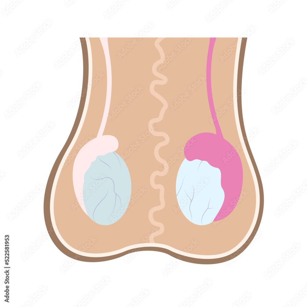 Illustration of epididimis inflamation on one of testicles compared to healthy one. Infographics in human anatomy for educational and marketing materials.