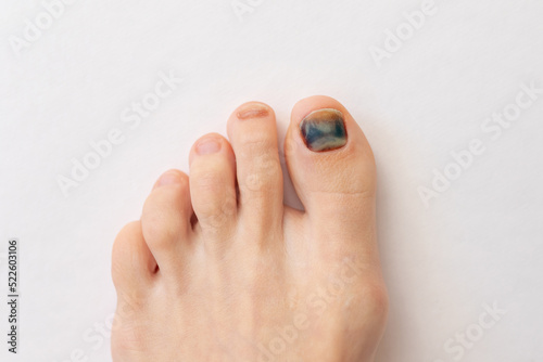 Subungual hematoma present under the toenail of the hallux, more commonly known as the big toe. broken toenail is when blood forms under a fingernail or toenail. Blue black toenail. photo