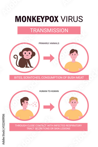 Monkeypox virus transmission. Monkeypox virus outbreak detailed infographics world health organization. Infected people spreading from monkey. Flat design with icons