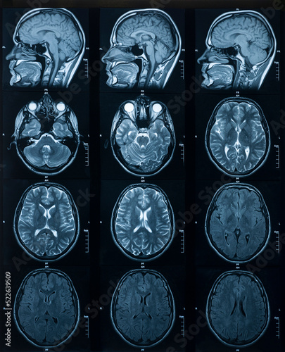 MRI scan of the brain. Medicine and Health