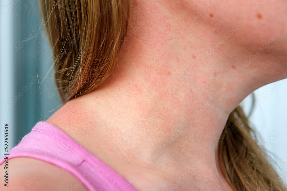 allergic-dermatitis-on-skin-of-woman-s-neck-skin-disease