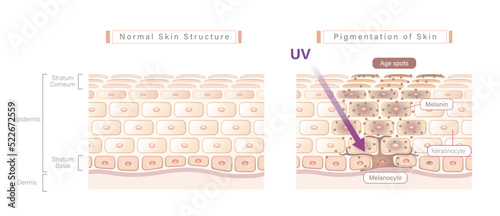 Vector skin structure illustration, comparison between healthy skin and skin pigmentation (age spot). Simple and best for educational and marketing materials. photo