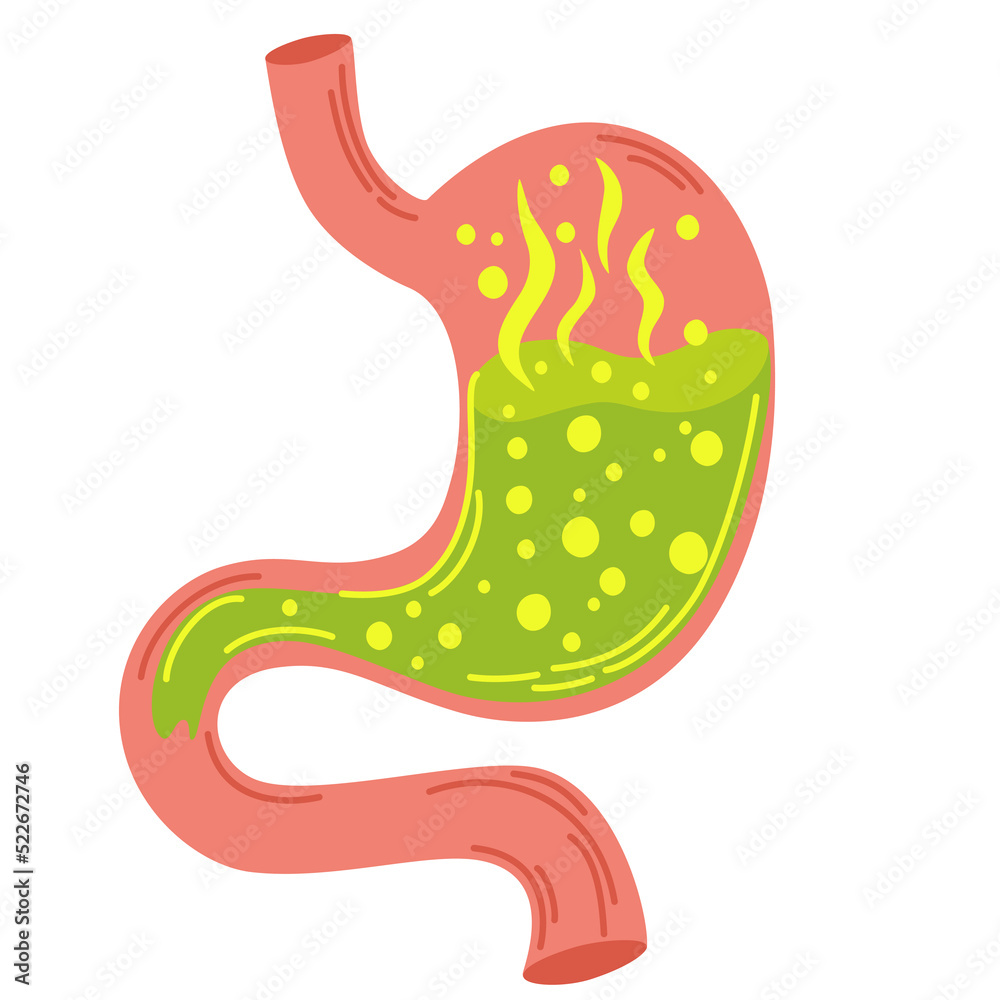 Human Stomach Gastritis And Acid Reflux Indigestion Vomiting human-stomach-gastritis-and-acid-reflux-indigestion-vomiting