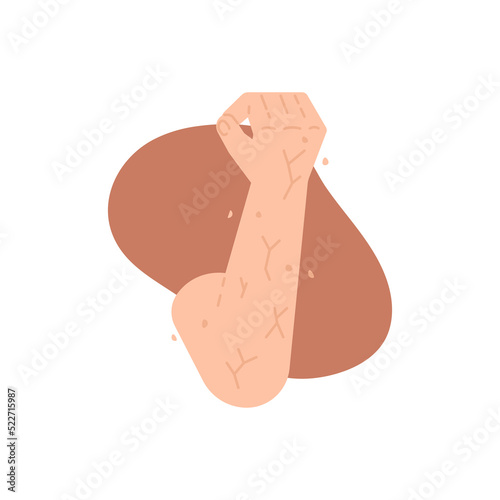 Xerosis, a dry and peeling skin condition. the skin on the hands is scaly and dry. lack of moisture in the skin and lack of water content. health. flat cartoon illustration. vector concept design