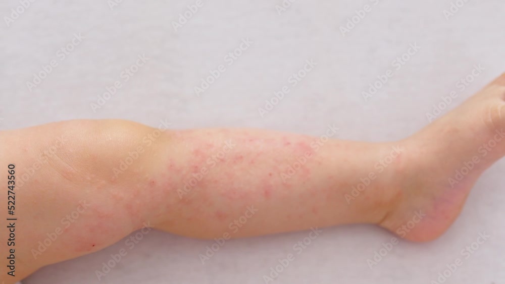 Video Stock atopic eczema dermatitis sleeping baby legs, red irritation