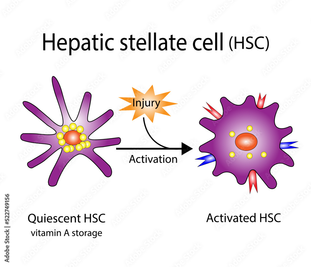 Hepatic stellate cell activation. Quiescent and activated HSCs. Hepatic