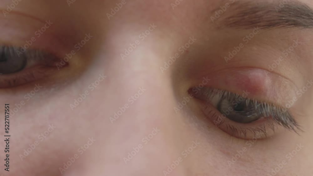 Painful red upper eye lid with onset of stye infection due. Close up of young woman with blue eye with stye infection. Painful red upper eye lid with onset of stye infection due. Close up of young woman with blue eye with stye infection.