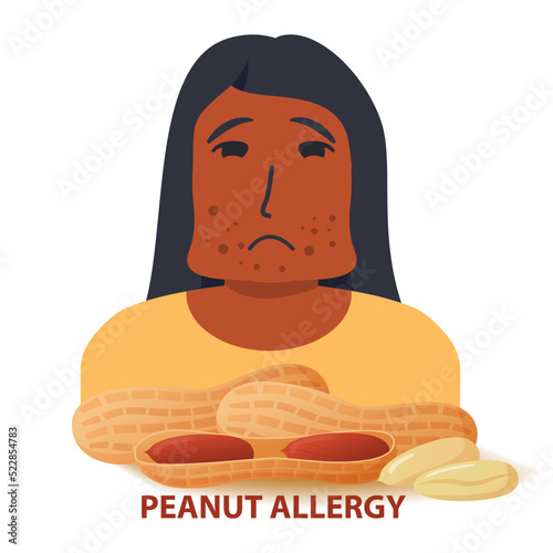 Nut allergy symptoms problem .Swollen man character.Allergic reaction to peanuts girl.Flat illustration vector.Isolated on a white background.