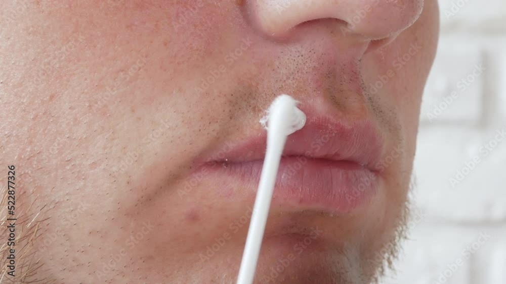 Herpes on the lip of a young man, apply the ointment to the wound on