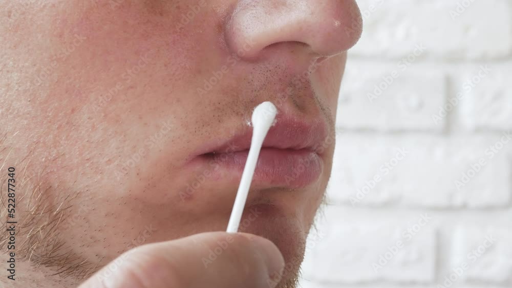 Video „Herpes on the lip of a young man, on a cotton swab, apply the ointment to the wound on