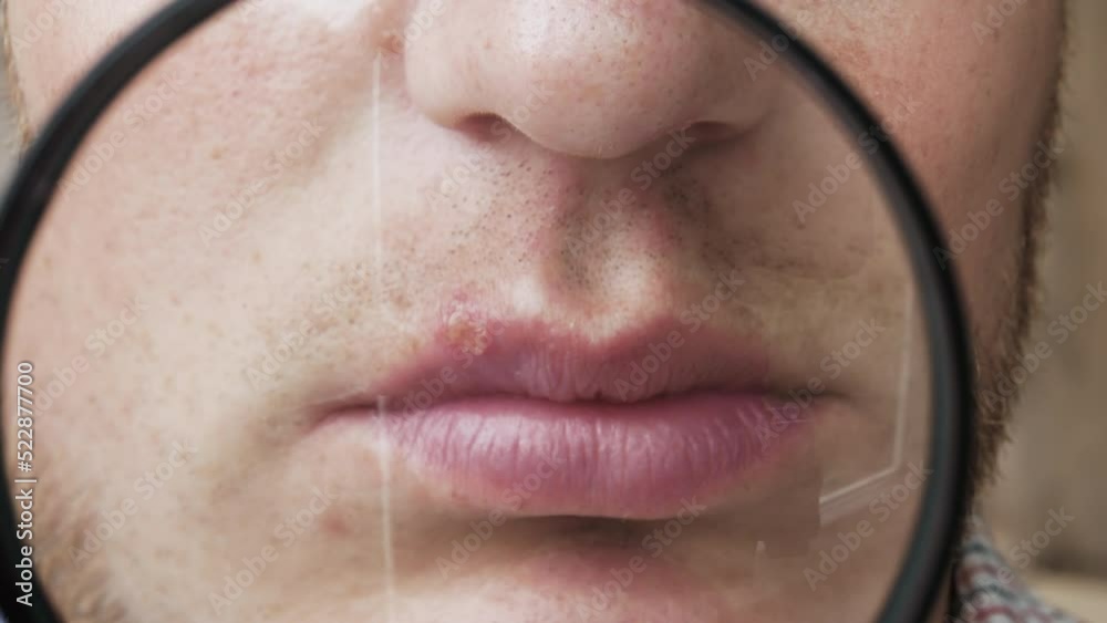 Closeup Herpes on the lip of a man through a magnifying glass, pimple