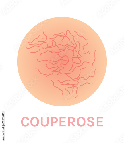 Couperose and Rosacea. Dermatological Disease. Red Capillaries on the Skin. Vector illustration for Medical Design and Education.