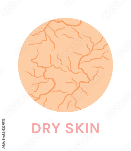 Dry Unhealthy Skin. Close-up. Facial and Body Skin Problems. Color Cartoon style. Circle. Zoom. White background. Vector illustration for Beauty Design.