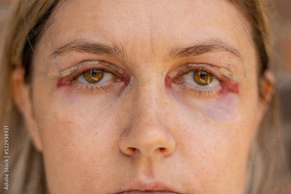 double-eyelid-surgery-eyes-surgery-recover-period-immediately-after