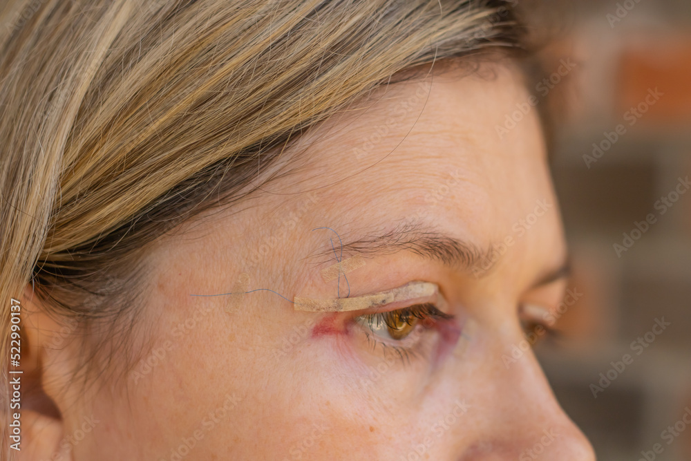 Double Eyelid Surgery, Eyes Surgery Recovery Period, immediately after