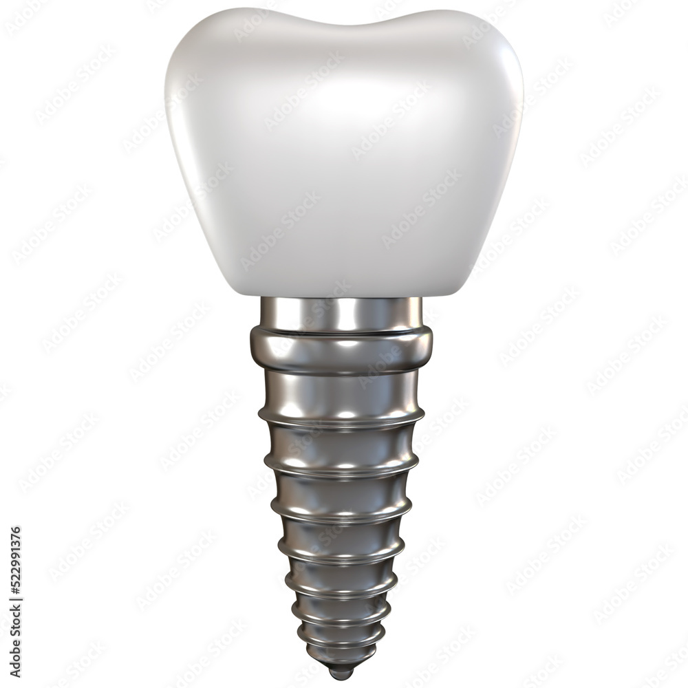 Dental tooth implant 3d render. Dental tooth implant 3d render.