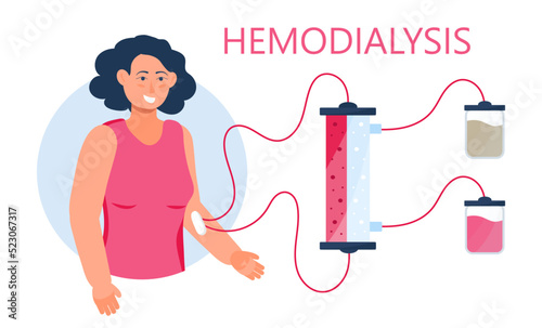 Hemodialysis concept vector. Method of extrarenal blood purification in acute and chronic renal failure.
