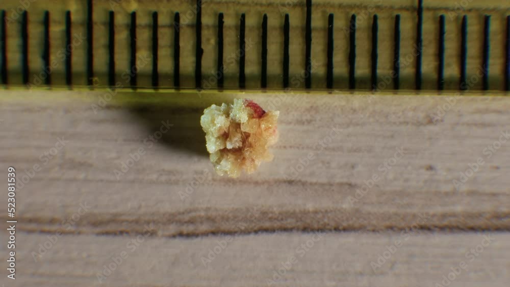 Oxalate kidney stone 4 mm, the stone was removed from the kidney, close