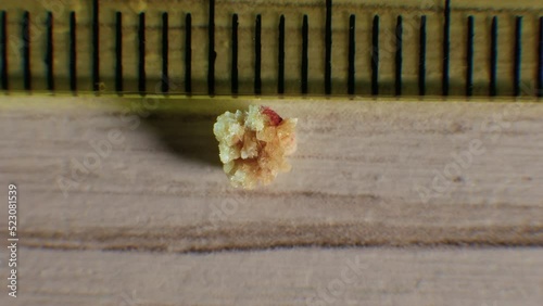 Oxalate kidney stone 4 mm, the stone was removed from the kidney, close-up of the kidney stone. Natural stone formed in the human kidney photo