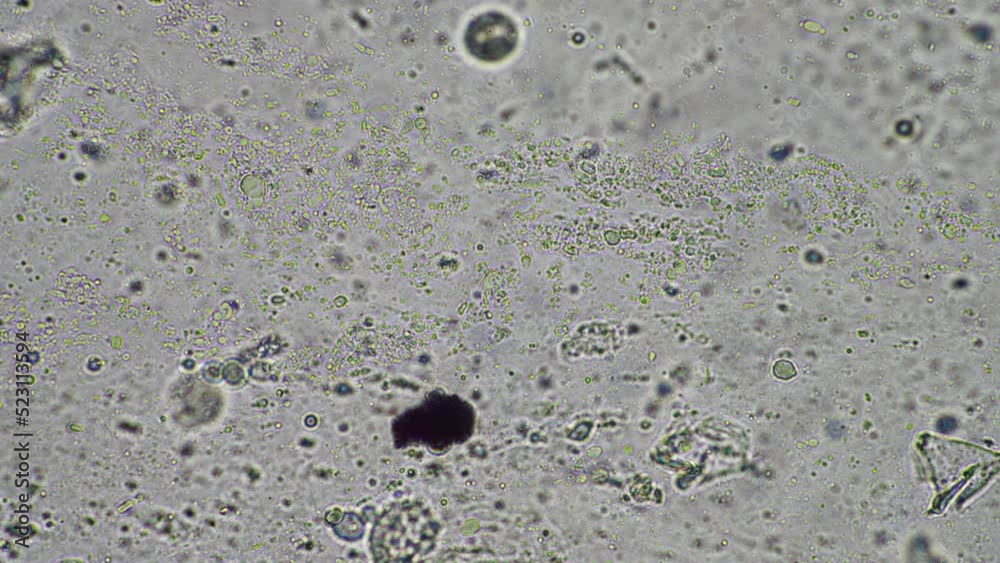 Coughing up mucus and phlegm from a chest infection from a virus and