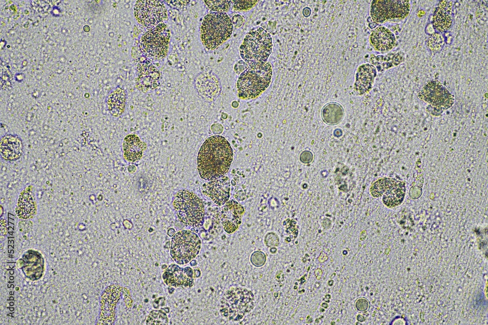 person with a virus coughing, Phlegm and mucus under the microscope ...