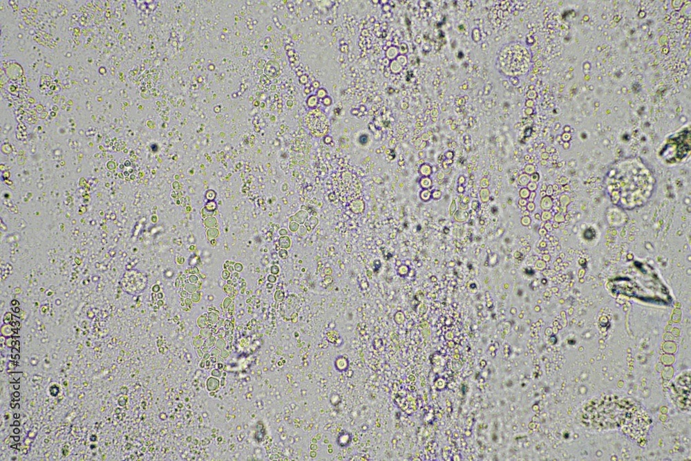 person with a virus coughing, Phlegm and mucus under the microscope ...