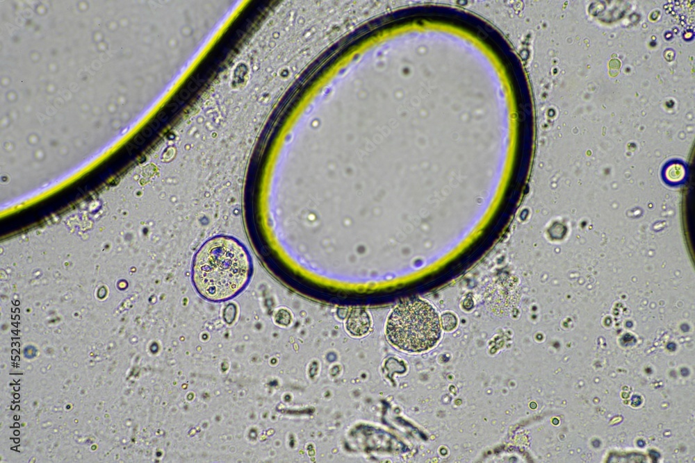 Coughing up mucus and phlegm from a chest infection from a virus and ...