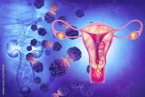 Female reproductive system diseases. Uterus cancer and endometrial malignant tumor as a uterine medical concept. 3d illustration