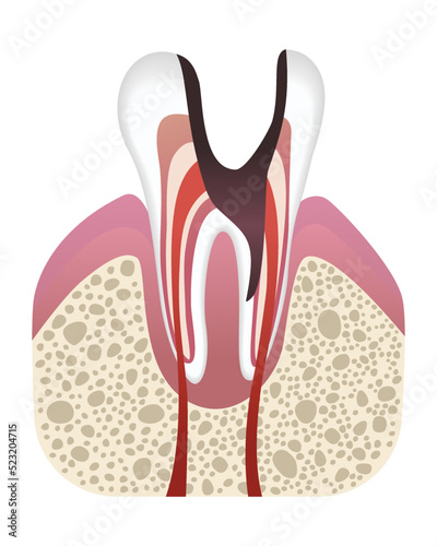 Stage of caries development. Tooth structure in flat style. Tooth decay with enamel. Dental disease realistic vector illustration